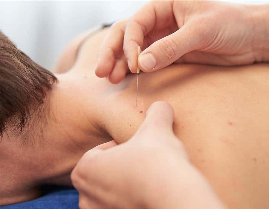 trigger points dry needling