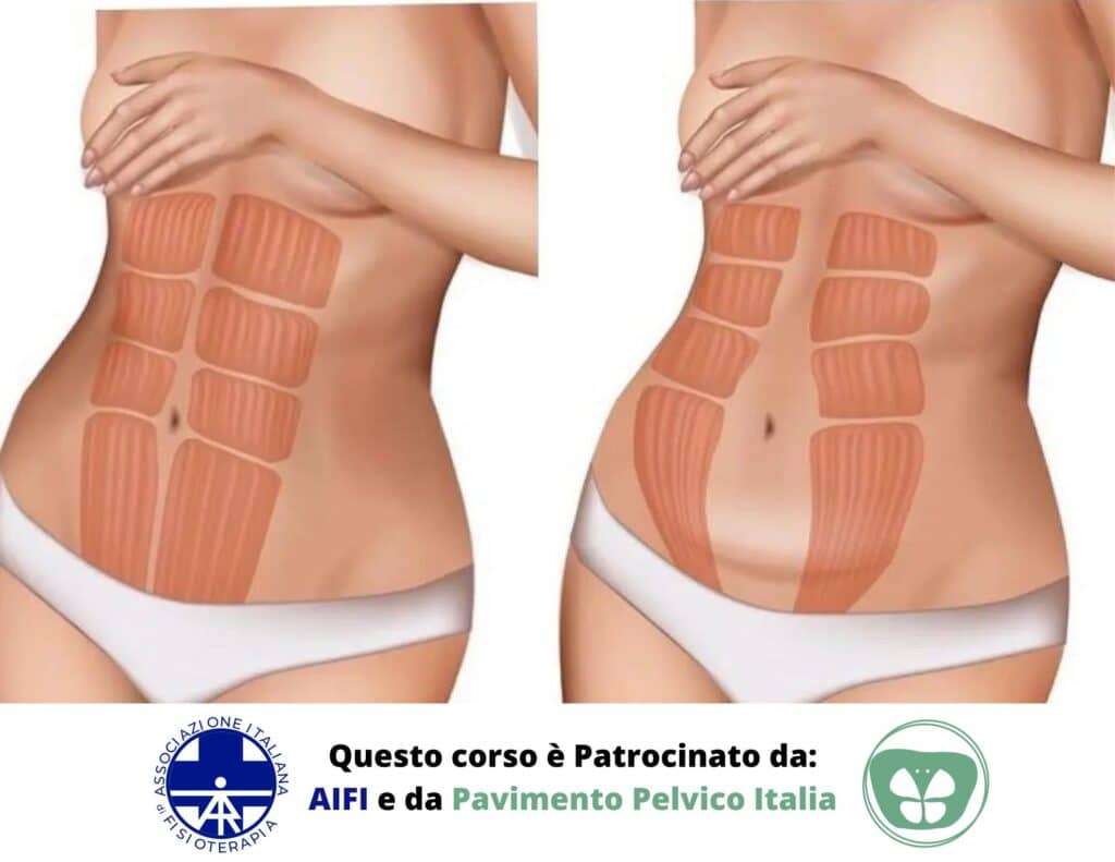 Diastasi addominale corsi ecm per fisioterapisti