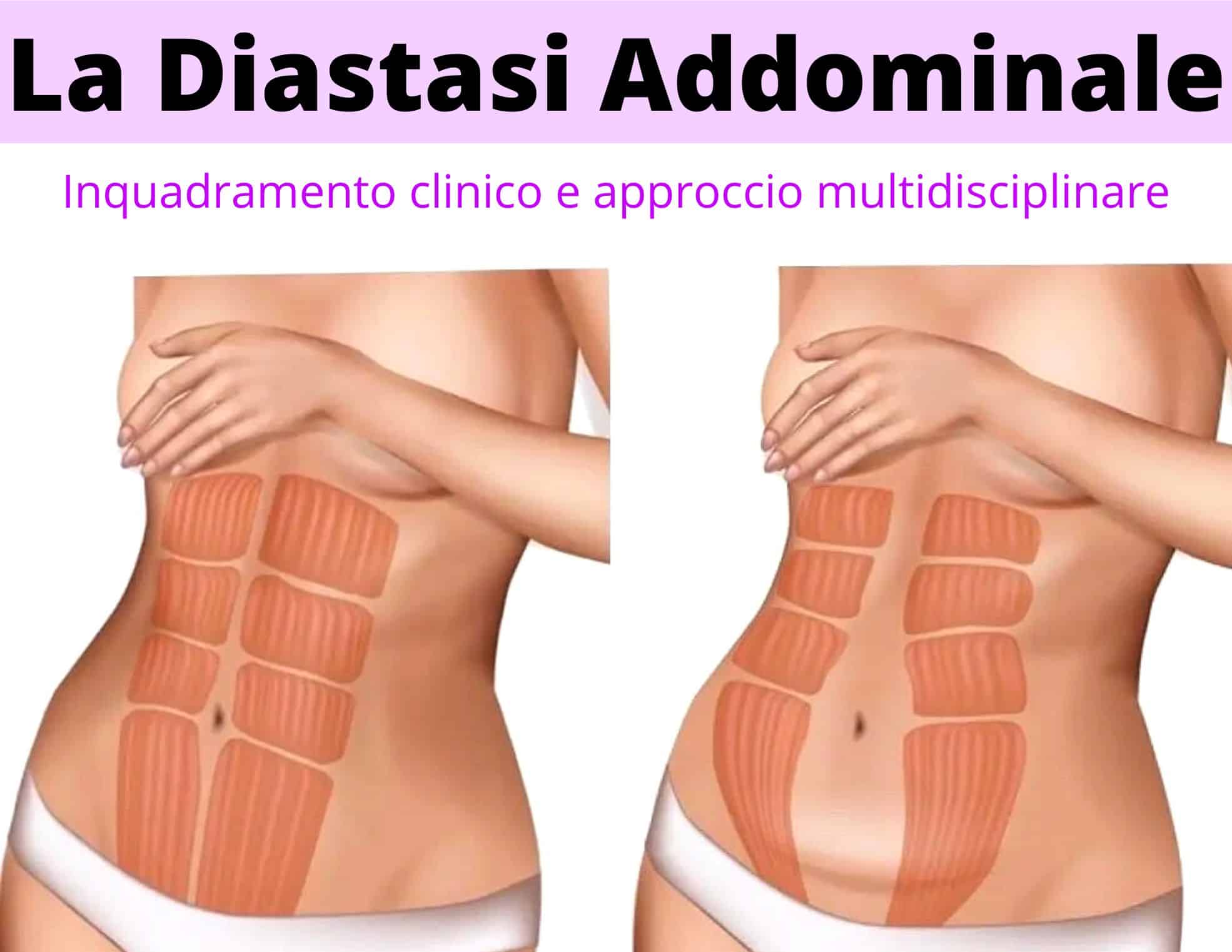 La diastasi addominale corso ecm per fisioterapisti